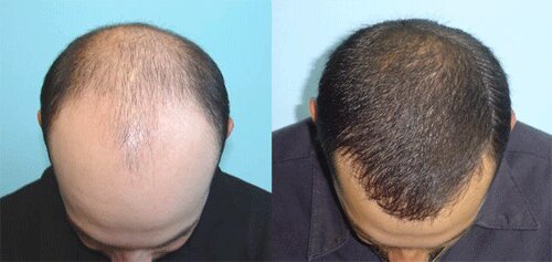 زراعة الشعر في مصر مع أوروم (صورة توضيحية)